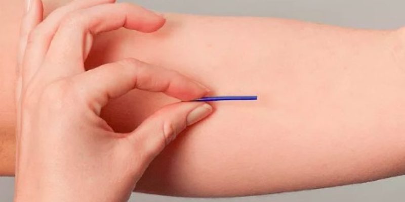 Implantes hormonais, famosos “chips da beleza”, são suspendidos pela Anvisa. – Foto: Internet/Reprodução