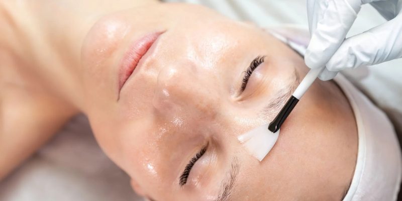 Peeling de fenol é um procedimento que utiliza ácido para rejuvenescer a pele e tem recuperação dolorosa
Kyryl Gorlov/GettyImages