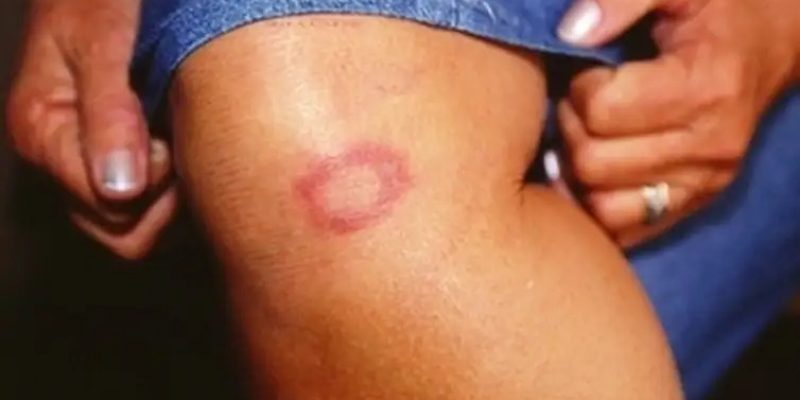 Não ter uma fonte de renda também pode ser um elemento que transforma a hanseníase em uma ameaça real - Divulgação