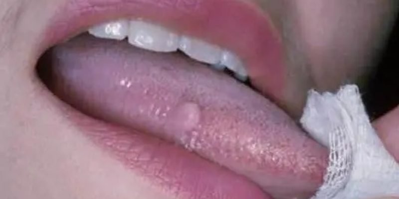 Existem mais de 100 tipos, sendo pelo menos 14 cancerígenos