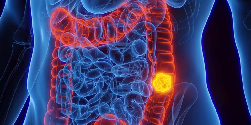 O Câncer Colorretal é uma das neoplasias mais frequentes no mundo, com impactos significativos na saúde pública