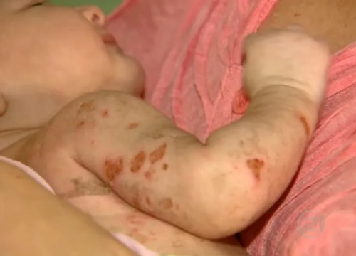 Bolhas em bebês são causadas pela chikungunya — Foto: Reprodução/TV Globo