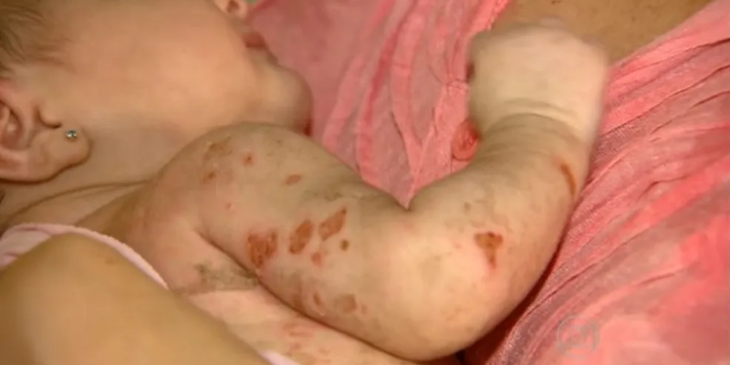 Bolhas em bebês são causadas pela chikungunya — Foto: Reprodução/TV Globo