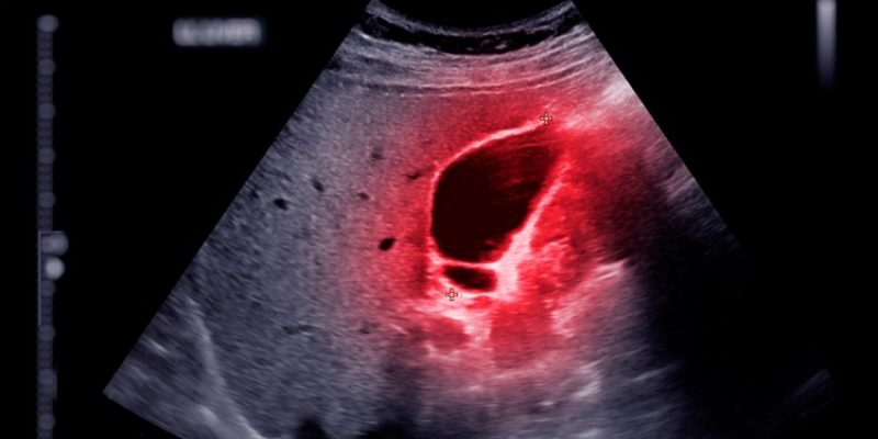 Image- Diagnóstico câncer de pâncreas
