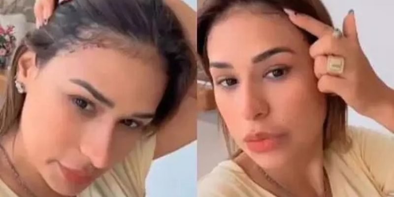 Simone Mendes explicou nova cirurgia - Reprodução Instagram